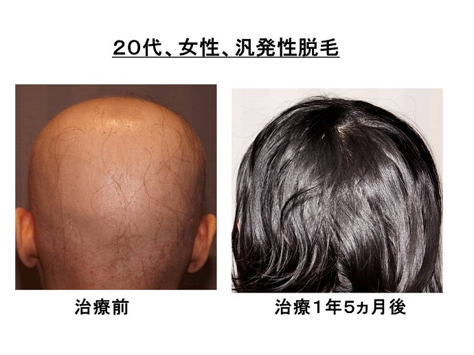 円形脱毛症　病院